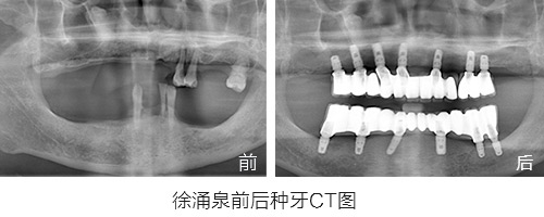 500-200-种牙前后对比图.jpg