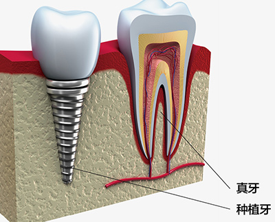 种植牙