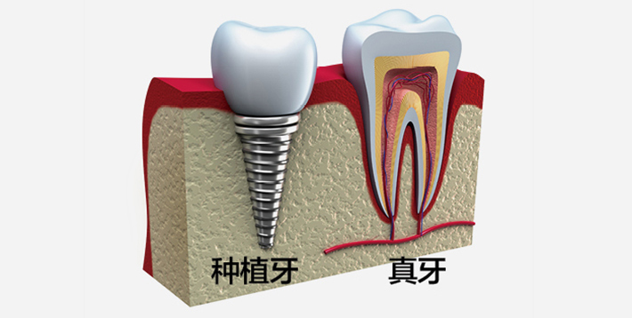 种植牙与真牙对比